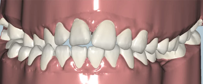 3D-скан зубов